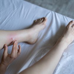 Flöhe im Bett erkennen – Ursachen, Anzeichen – Ratgeber